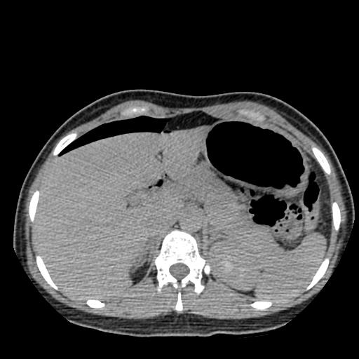 File:Choriocarcinoma of ovary with cerebral and pulmonary metastases (Radiopaedia 25983-26119 Axial non-contrast 80).jpg