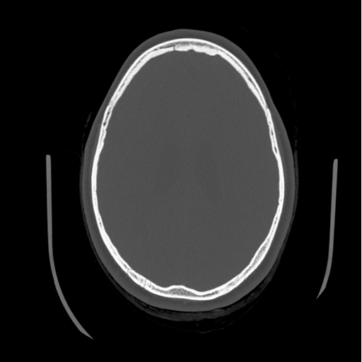 Choroid plexus papilloma extending into the cerebellopontine angle cistern (Radiopaedia 85941-101833 Axial bone window 63).png