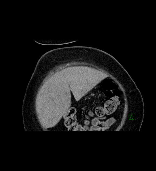 Chromophobe renal cell carcinoma (Radiopaedia 84239-99519 C 13).jpg