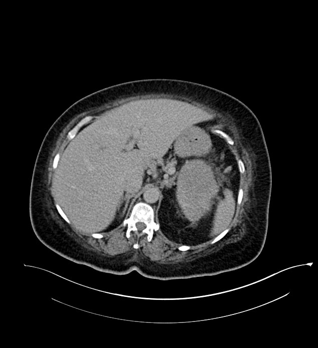 Chromophobe renal cell carcinoma (Radiopaedia 84239-99519 E 52).jpg