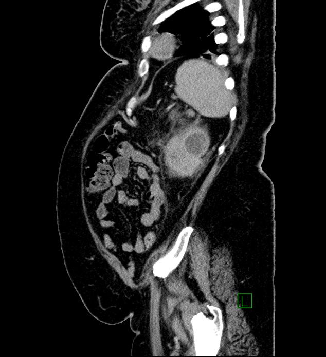 Chromophobe renal cell carcinoma (Radiopaedia 84239-99519 G 25).jpg