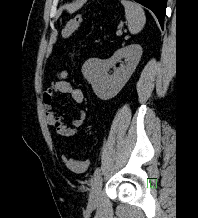 Chromophobe renal cell carcinoma (Radiopaedia 84286-99573 C 45).jpg