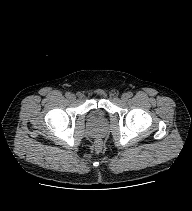 Chromophobe renal cell carcinoma (Radiopaedia 84337-99693 Axial non-contrast 158).jpg
