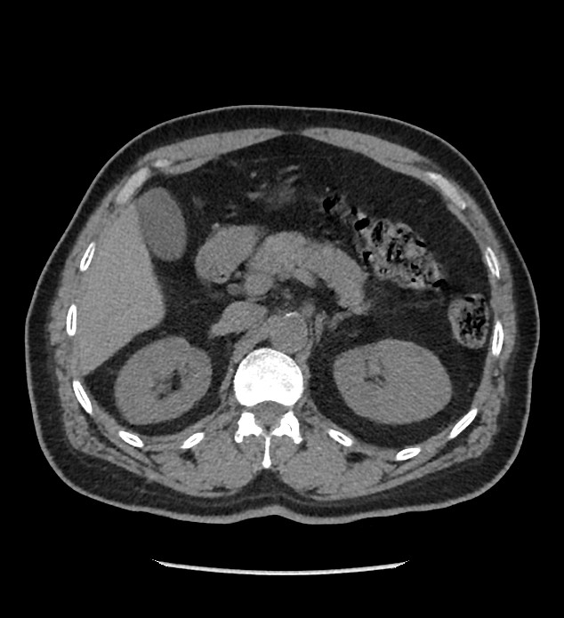 Chromophobe renal cell carcinoma (Radiopaedia 86879-103083 Axial non-contrast 27).jpg
