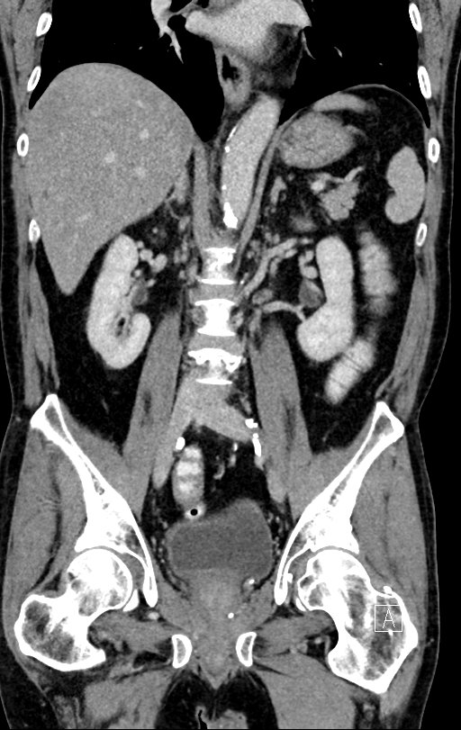 Chronic appendicitis complicated by appendicular abscess, pylephlebitis and liver abscess (Radiopaedia 54483-60700 C 48).jpg