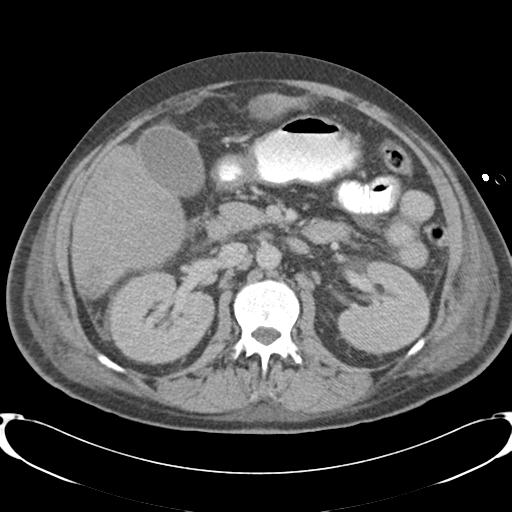 Chronic diverticulitis complicated by hepatic abscess and portal vein thrombosis (Radiopaedia 30301-30938 A 41).jpg