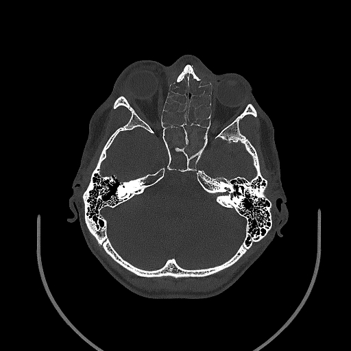 Chronic invasive fungal sinusitis (Radiopaedia 50342-55710 Axial bone window 74).jpg
