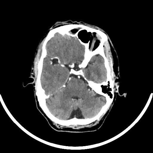 Chronic invasive fungal sinusitis with intraorbital and intracranial extension (Radiopaedia 56387-63046 B 122).jpg
