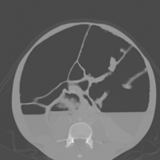 Chronic large bowel pseudo-obstruction (Radiopaedia 43181-46492 Axial bone window 108).jpg