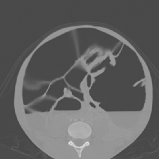 Chronic large bowel pseudo-obstruction (Radiopaedia 43181-46492 Axial bone window 114).jpg