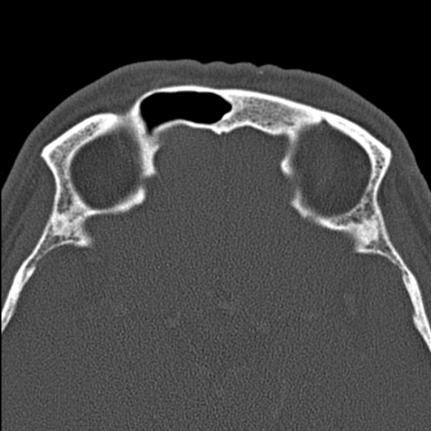 Chronic maxillary sinusitis (Radiopaedia 27879-28116 Axial bone window 45).jpg