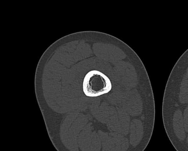 Chronic ostemyelitis of the femur with long sinus tract (Radiopaedia 74947-85982 Axial bone window 111).jpg