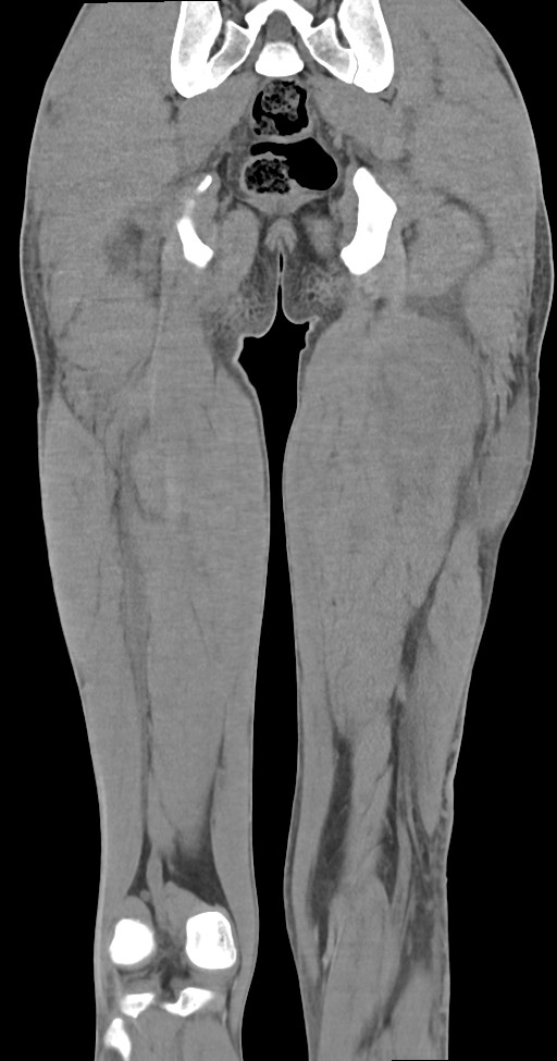 Chronic osteomyelitis (with sequestrum) (Radiopaedia 74813-85822 E 42).jpg
