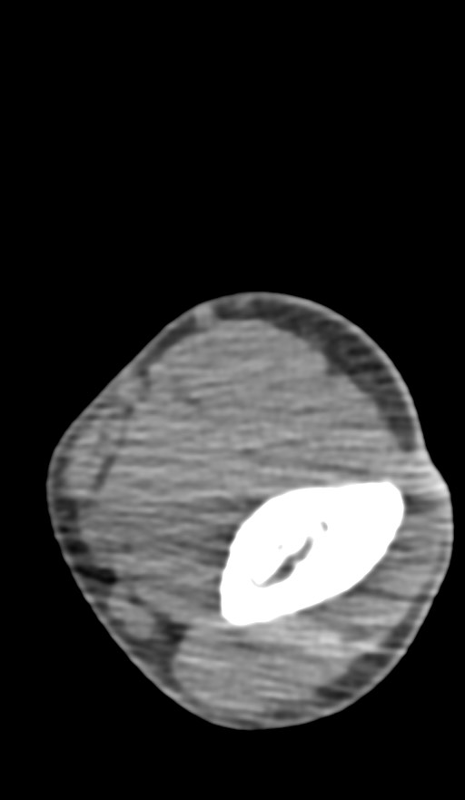 Chronic osteomyelitis of the distal humerus (Radiopaedia 78351-90971 Axial non-contrast 77).jpg