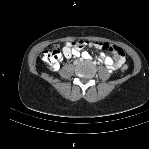 File:Chronic pancreatitis (Radiopaedia 64576-73450 B 105).jpg
