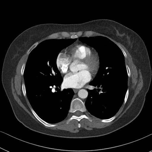 Chronic pulmonary embolus (Radiopaedia 39129-41341 Axial C+ CTPA 61).png