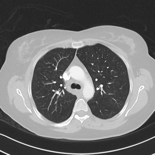 Chronic pulmonary embolus (Radiopaedia 39129-41341 Axial lung window 23).png