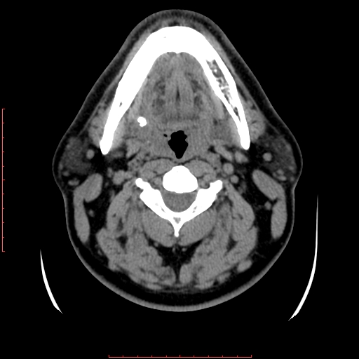 Chronic submandibular sialolithiasis (Radiopaedia 69817-79814 Axial non-contrast 100).jpg