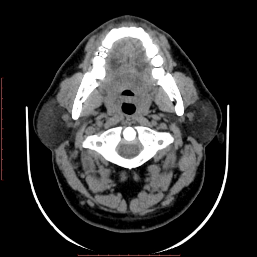 Chronic submandibular sialolithiasis (Radiopaedia 69817-79814 Axial non-contrast 67).jpg