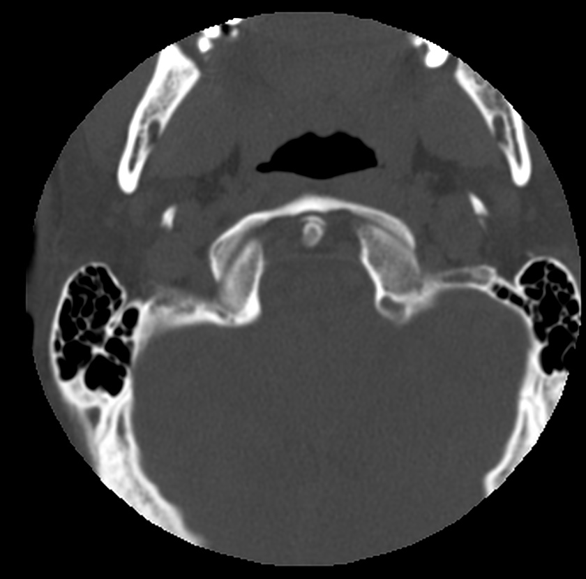 Clay-shoveler fracture (Radiopaedia 22568-22590 Axial bone window 4).jpg