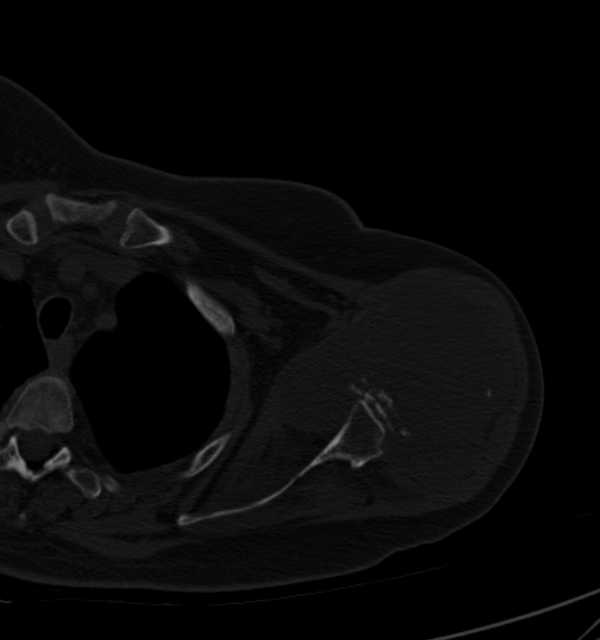 Clear cell chondrosarcoma - humerus (Radiopaedia 63104-71612 Axial bone window 39).jpg