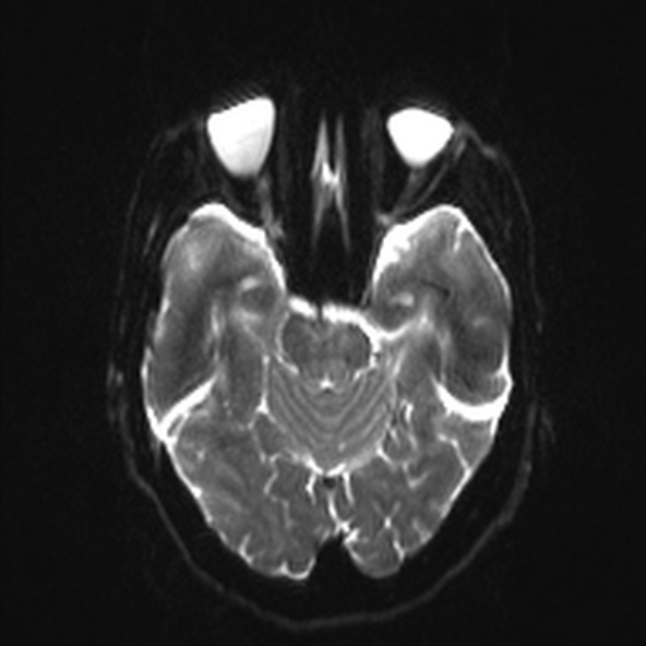 File:Clival meningioma (Radiopaedia 53278-59248 Axial DWI 8).jpg