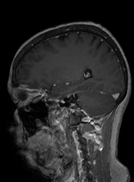 Clival meningioma (Radiopaedia 53278-59248 Sagittal T1 C+ 212).jpg
