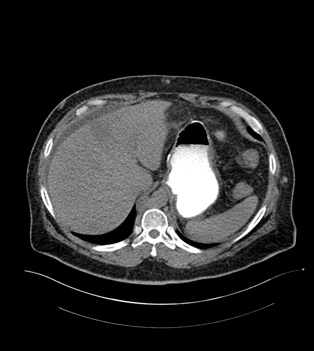 Closed-loop small bowel obstruction-internal hernia (Radiopaedia 78439-91096 Axial non-contrast 30).jpg