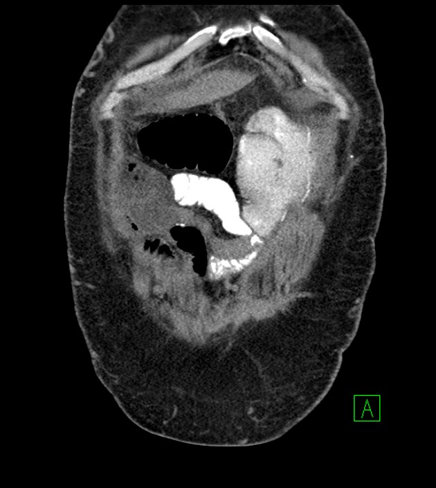 Closed-loop small bowel obstruction-internal hernia (Radiopaedia 78439-91096 Coronal non-contrast 21).jpg