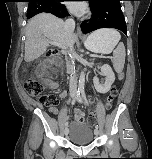 File:Closed loop obstruction - internal hernia into nephrectomy bed (Radiopaedia 59867-67320 B 71).jpg
