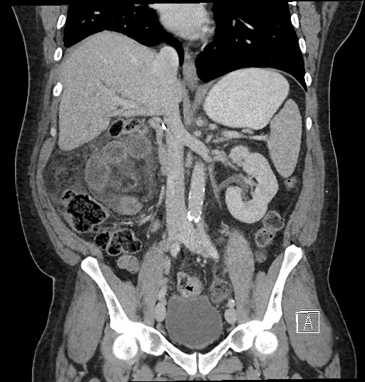 Closed loop obstruction - internal hernia into nephrectomy bed (Radiopaedia 59867-67320 B 73).jpg