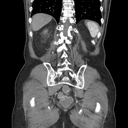 Closed loop obstruction due to adhesive band, resulting in small bowel ischemia and resection (Radiopaedia 83835-99023 C 99).jpg