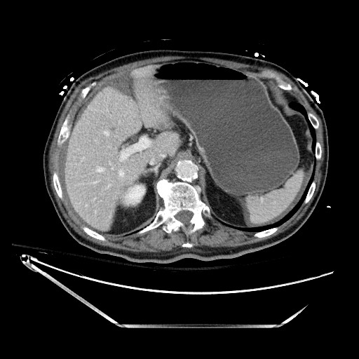 File:Closed loop obstruction due to adhesive band, resulting in small bowel ischemia and resection (Radiopaedia 83835-99023 D 41).jpg