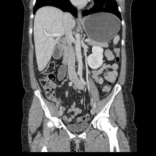 Closed loop small bowel obstruction (Radiopaedia 65403-74451 B 56).jpg