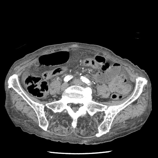 File:Closed loop small bowel obstruction - adhesions and infarct (Radiopaedia 85125-100678 A 119).jpg