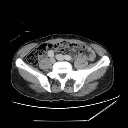 File:Closed loop small bowel obstruction - omental adhesion causing "internal hernia" (Radiopaedia 85129-100682 A 115).jpg