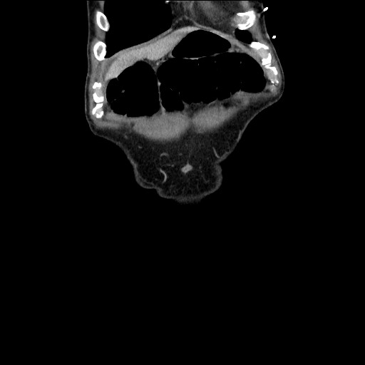 Closed loop small bowel obstruction - omental adhesion causing "internal hernia" (Radiopaedia 85129-100682 B 23).jpg