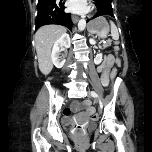 Closed loop small bowel obstruction due to adhesive band, with intramural hemorrhage and ischemia (Radiopaedia 83831-99017 C 77).jpg