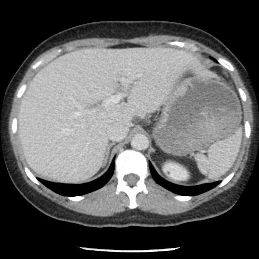 Closed loop small bowel obstruction due to trans-omental herniation (Radiopaedia 35593-37109 A 24).jpg