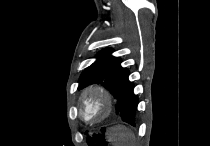 Coarctation of aorta with aortic valve stenosis (Radiopaedia 70463-80574 B 223).jpg