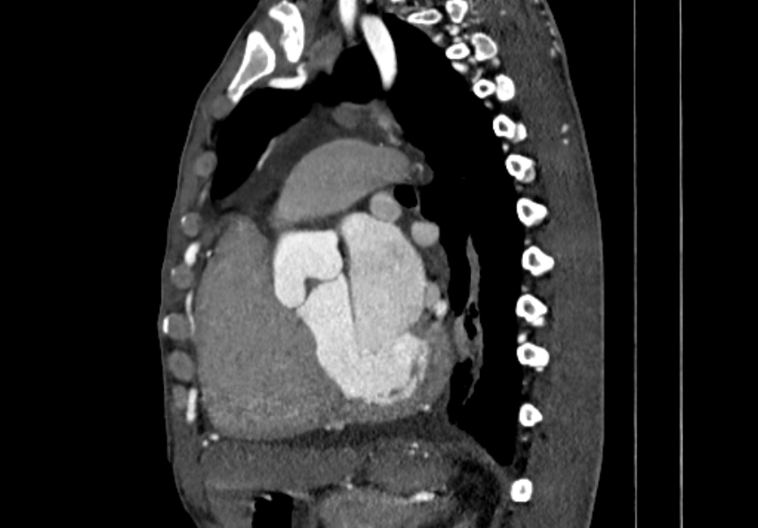 Coarctation of aorta with aortic valve stenosis (Radiopaedia 70463-80574 B 91).jpg