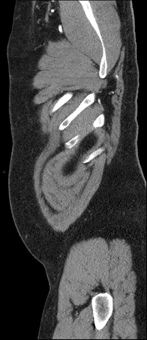 Coarctation of the aorta (Radiopaedia 74632-88521 C 12).jpg