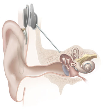 File:Cochlear implant (illustration) (Radiopaedia 36338).jpg