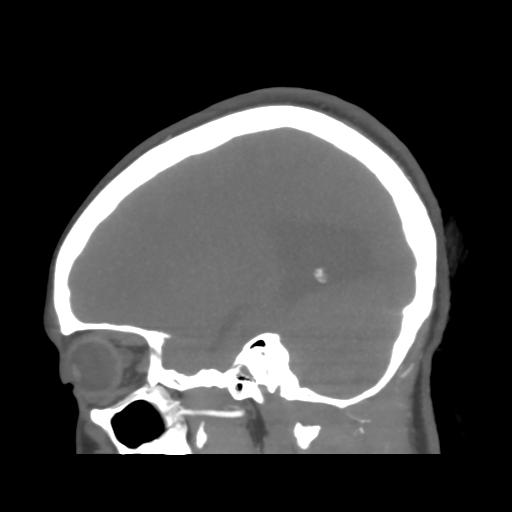 File:Colloid cyst (resulting in death) (Radiopaedia 33423-34499 B 17).png
