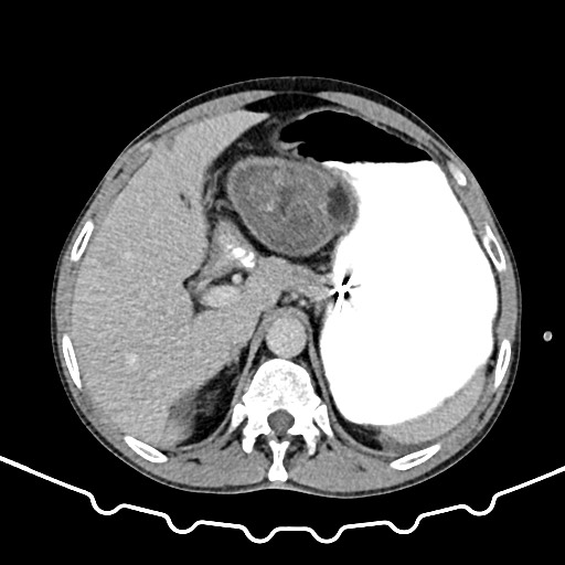 File:Colocolic intussusception due to large lipoma (Radiopaedia 68773-78482 A 38).jpg