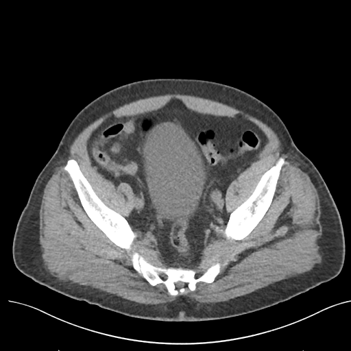 File:Colon adenocarcinoma - splenic flexure (Radiopaedia 34143-35406 Axial Oral contrast 74).png