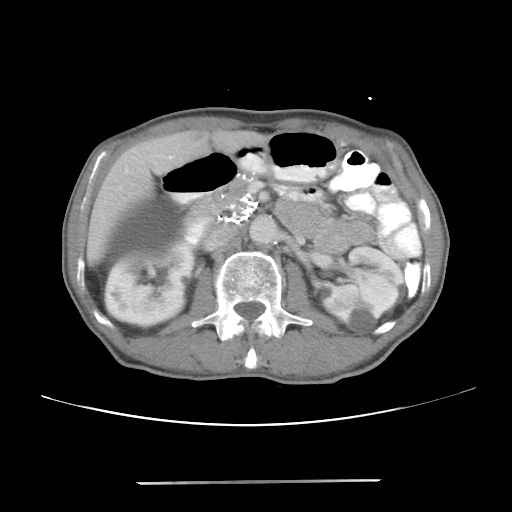 Colon cancer with calcified liver metastasis (Radiopaedia 74423-85307 A 29).jpg