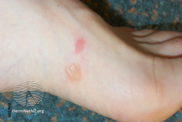 File:Friction blisters (DermNet NZ reactions-friction-blister-2).jpg