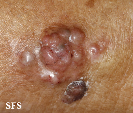 File:Melanoma (Dermatology Atlas 66).jpg