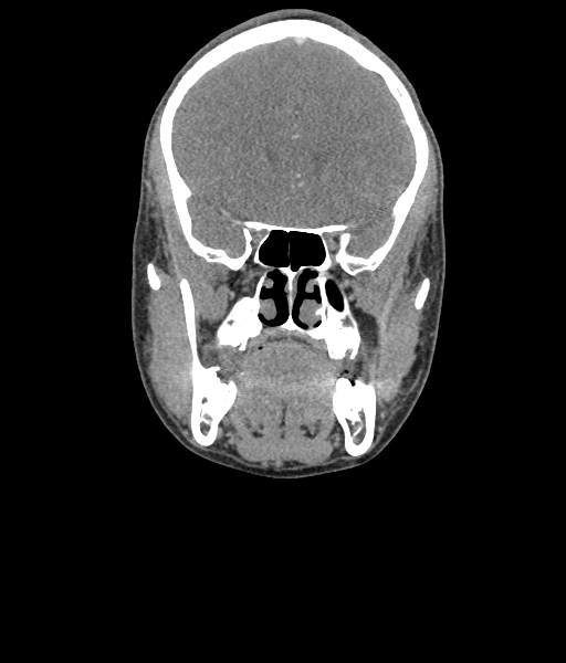 File:Nasal pyogenic granuloma (lobular capillary hemangioma) (Radiopaedia 85536-101244 D 56).jpg